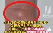 43岁男子手指异样怀疑感染HPV 竟是持机姿势不当所致